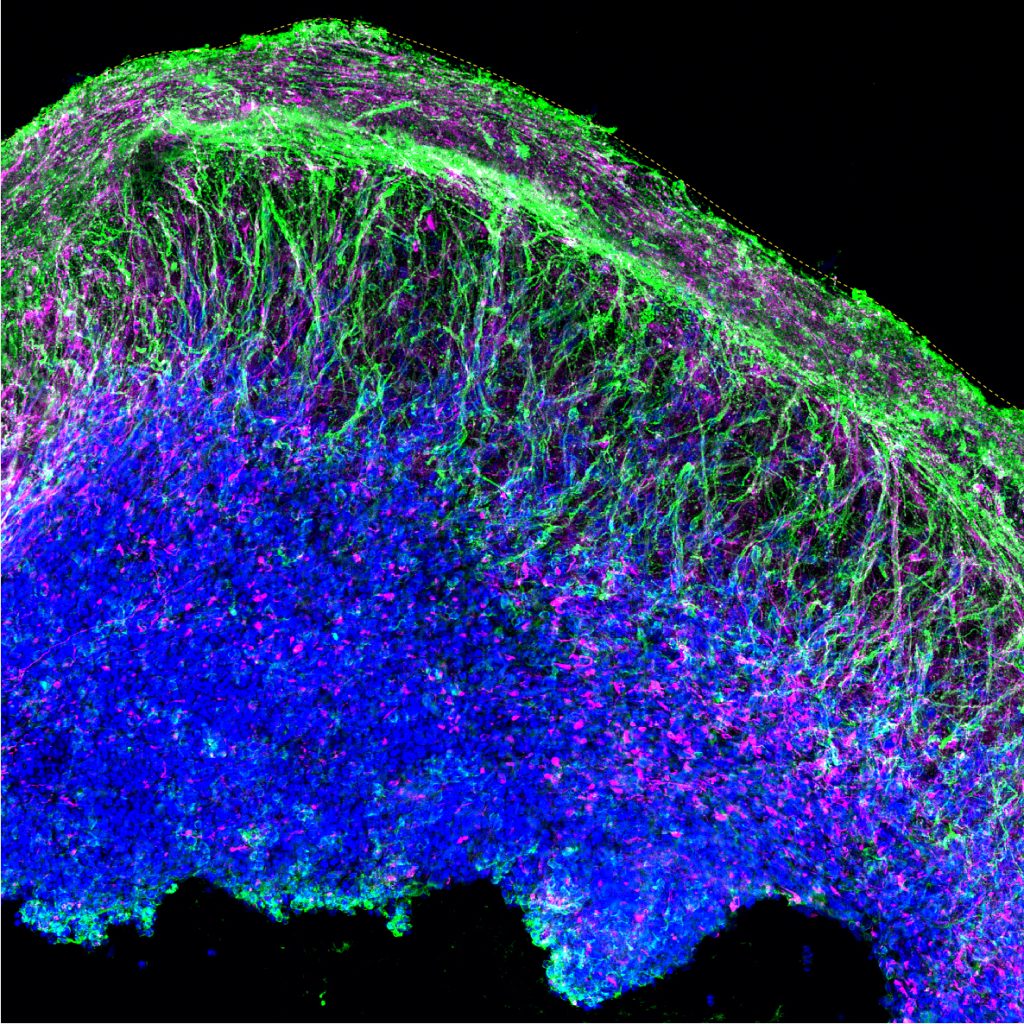 Brain like Organoids Grown In A Dish Provide Window Into Autism theU