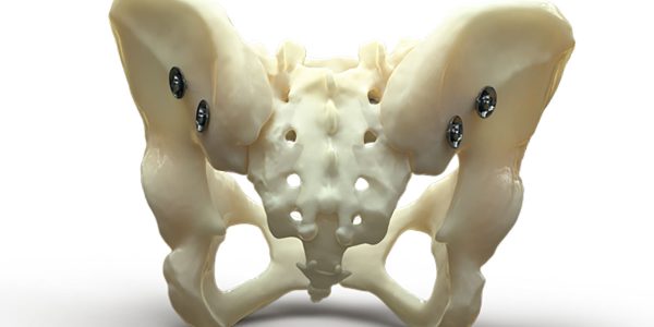 Device for treating challenging bone fractures cleared by FDA