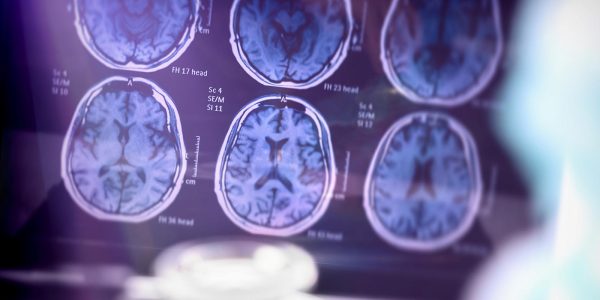 Studies document mysterious cluster of rare brain infections in kids