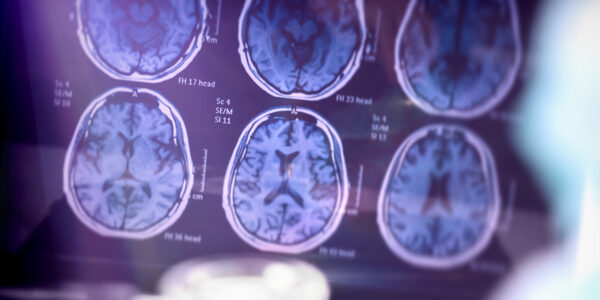Exploring the link between hypertension and dementia